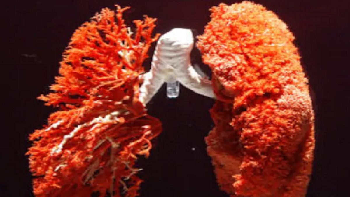 लैदर की गेंद जैसे सख्त फेफड़े कर देता है कोरोना, पहला इतना डरांवना केस