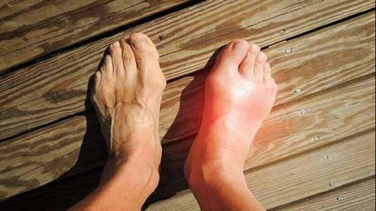 हाई यूरिक एसिड से 11 साल घट रही इंसान की उम्र, एक्सपर्ट ने दी ये 9 चीजें न खाने की सलाह