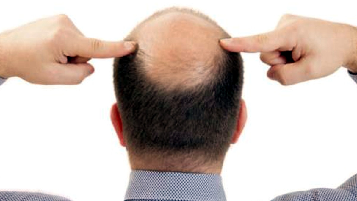 पति गंजा निकला तो नई नवेली सीए दुल्‍हन ने पुलिस में कराया केस दर्ज.