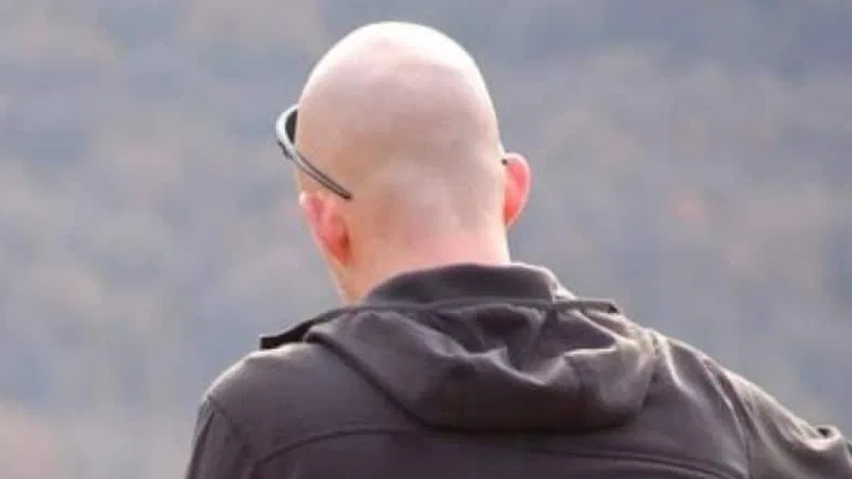 पति गंजा निकला तो नई नवेली सीए दुल्‍हन ने पुलिस में कराया केस दर्ज.