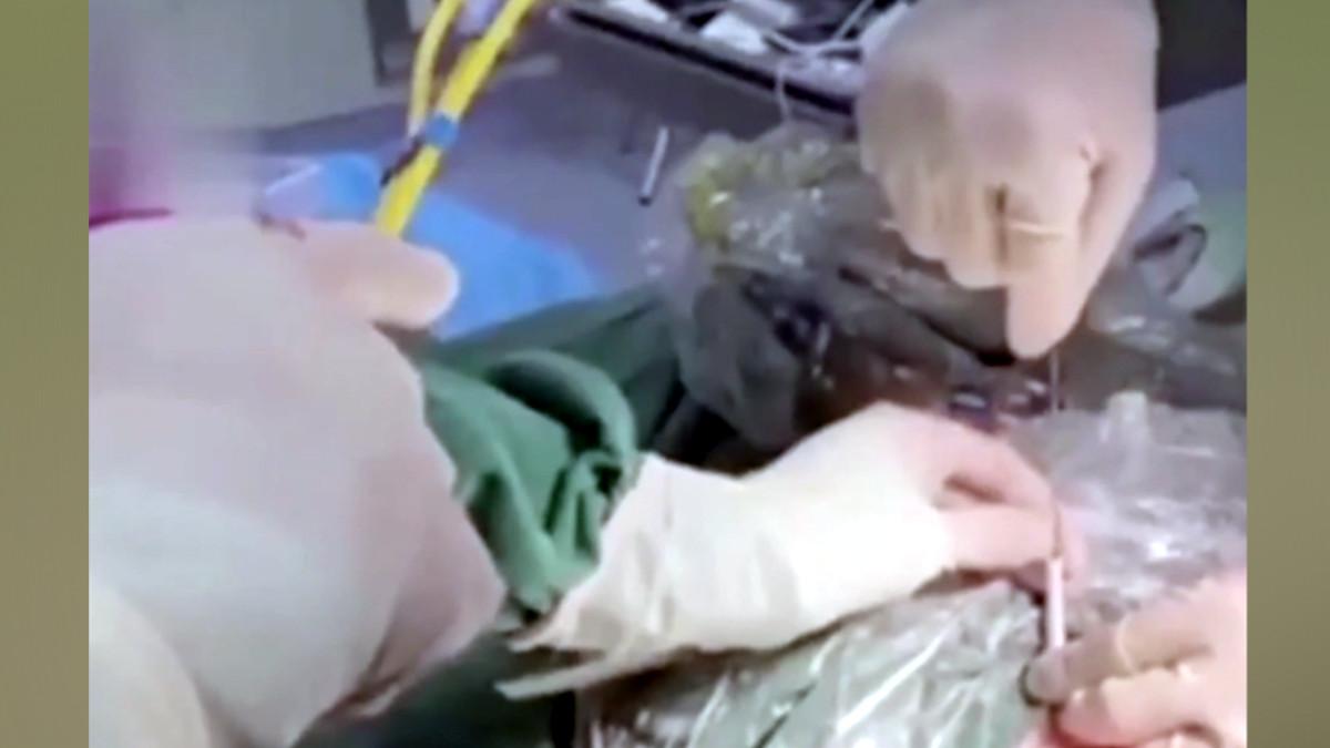 बच्‍चे का ऑपरेशन.