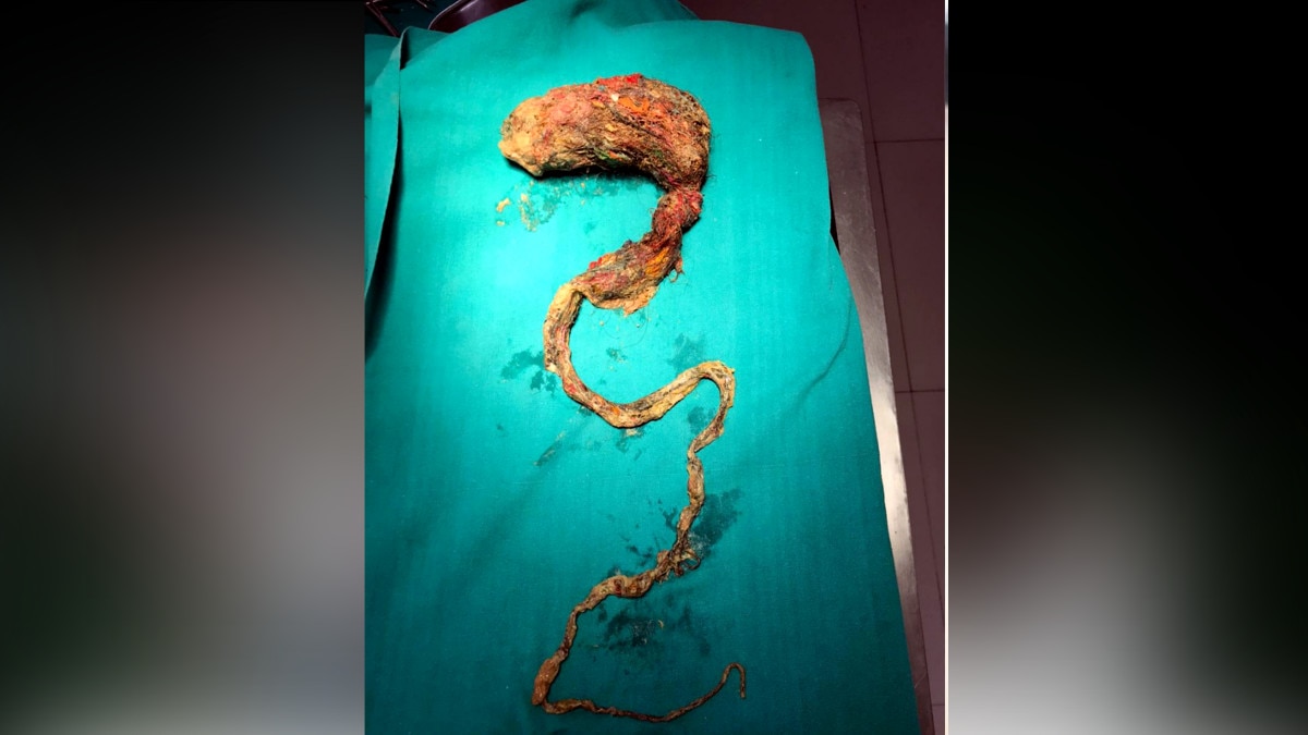 5 साल के बच्‍चे के ऑपरेशन से हैरान रह गए डॉक्‍टर