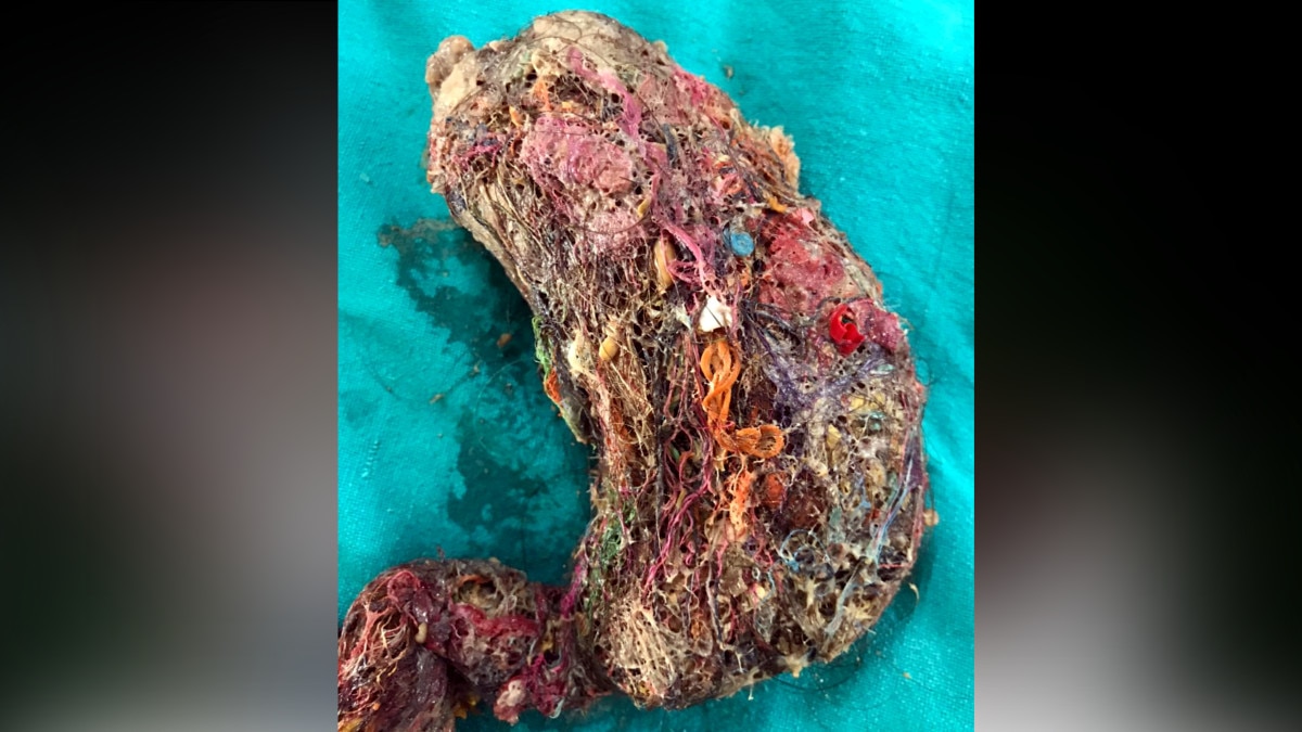 5 साल के बच्‍चे के ऑपरेशन से हैरान रह गए डॉक्‍टर