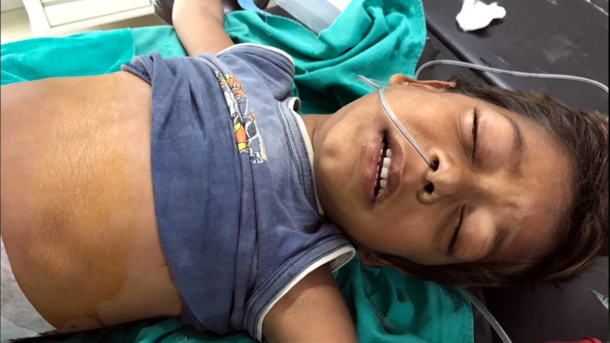 5 साल के बच्‍चे के ऑपरेशन से हैरान रह गए डॉक्‍टर