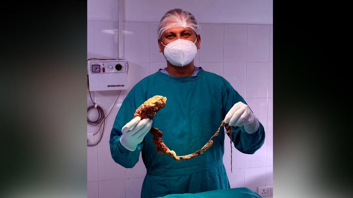 पेट से न‍िकला गुच्‍छा.