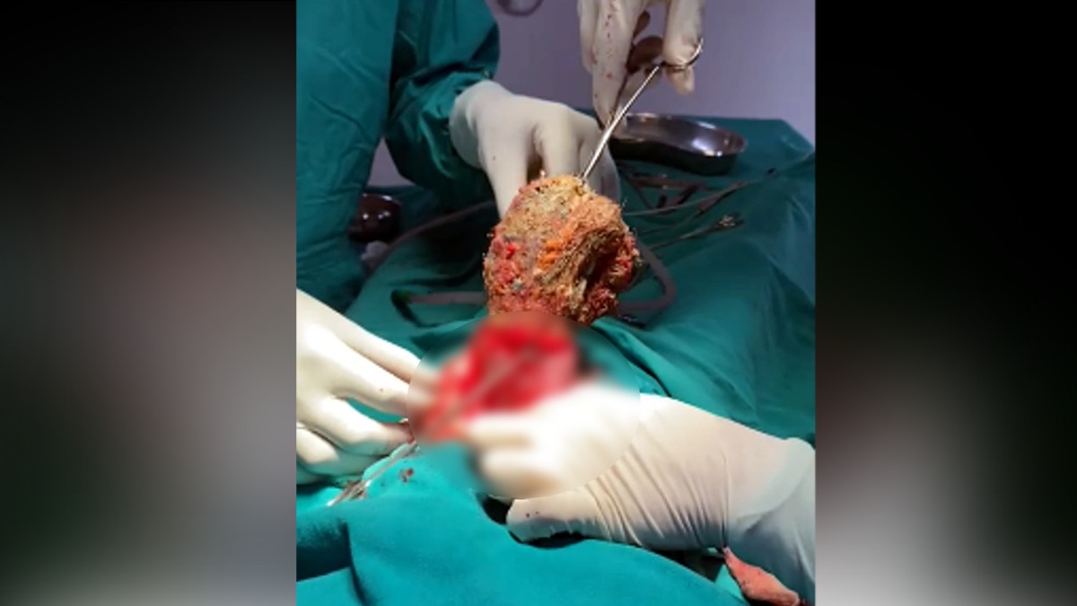 5 साल के बच्‍चे के ऑपरेशन से हैरान रह गए डॉक्‍टर