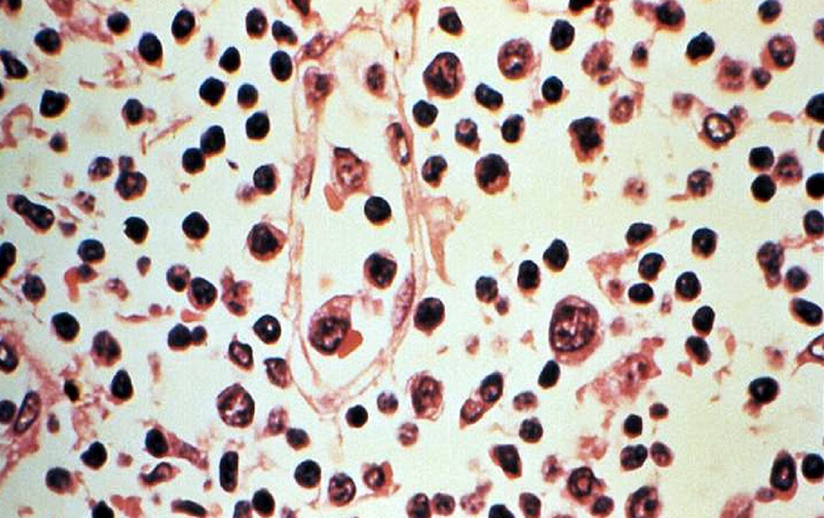 अफ्रीका में फैल रही खतरनाक बीमारी