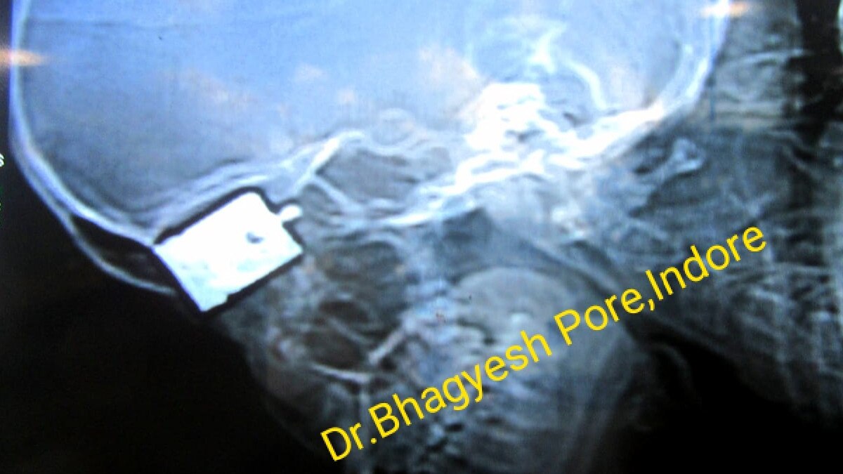 प्रेशर कुकर उठाते ही महिला के माथे में धंस गई सीटी, जान तो बची लेकिन आंख नहीं 