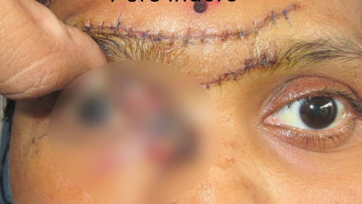 प्रेशर कुकर उठाते ही महिला के माथे में धंस गई सीटी, जान तो बची लेकिन आंख नहीं 