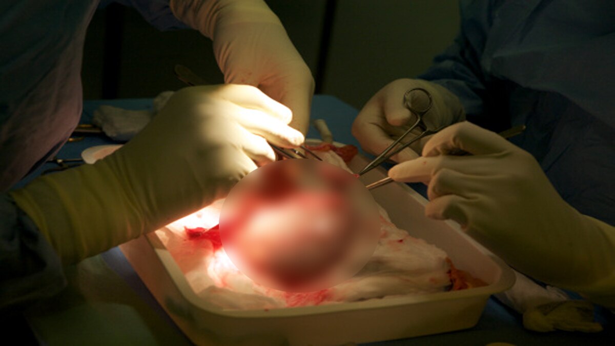 Patna Doctor removed second kidney instead of stone Bihar 