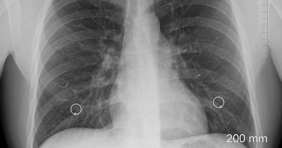 शरीर में फैल जाता है संक्रमण