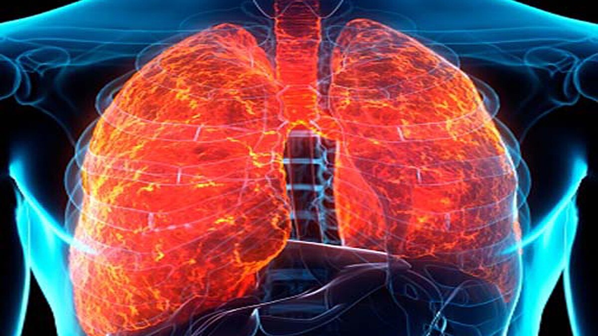 lung fibrosis in corona patients