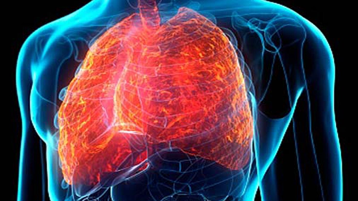 lung fibrosis in corona patients
