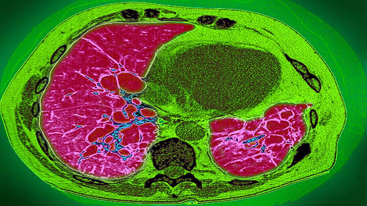 lung fibrosis in corona patients