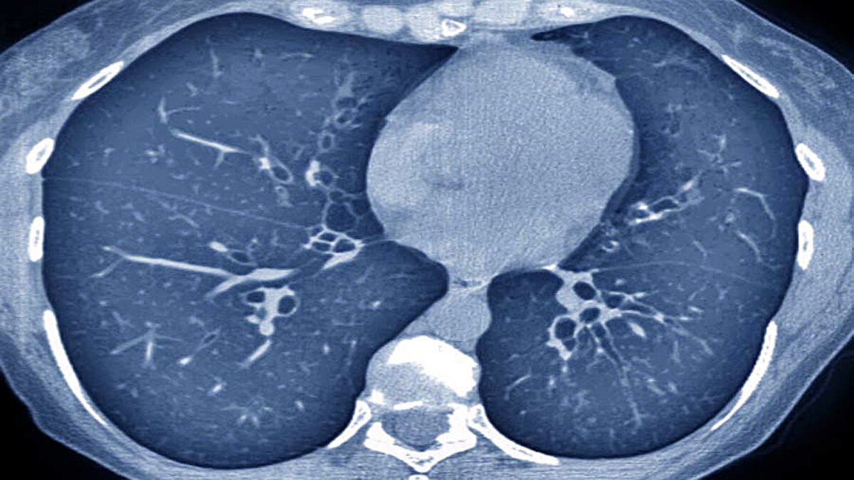 lung fibrosis in corona patients
