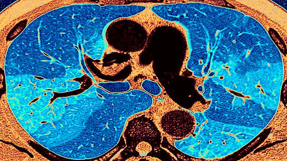 lung fibrosis in corona patients