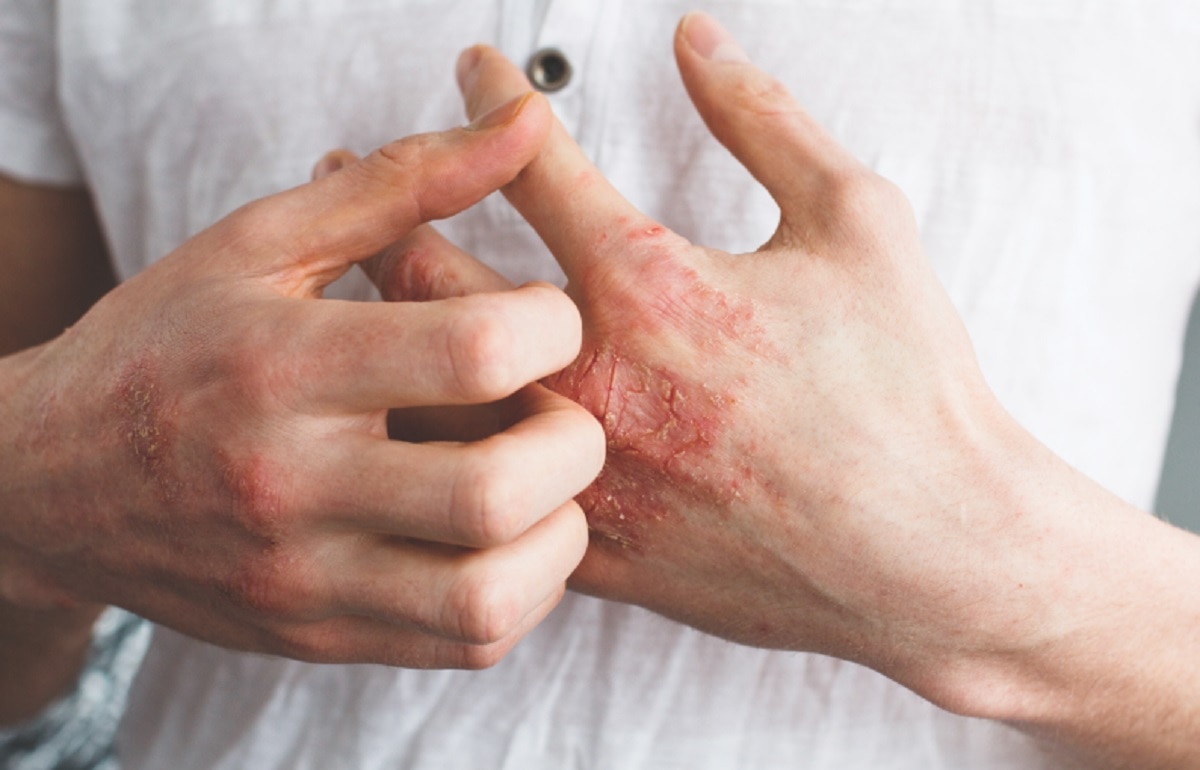 डर्माटाइटिस या एग्जेमा