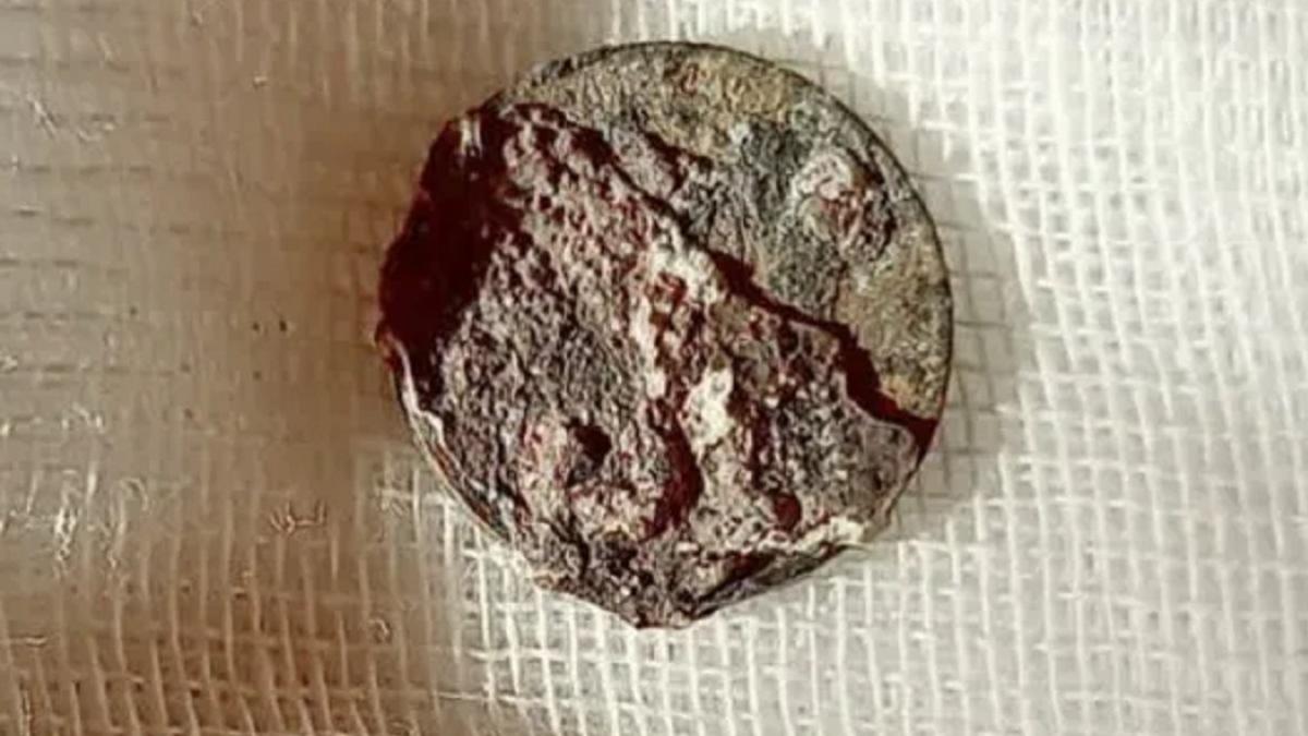 नाक से निकला सिक्का