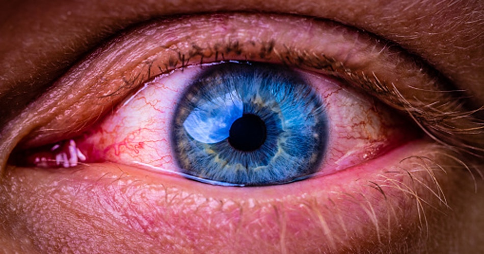 पलकों की सूजन