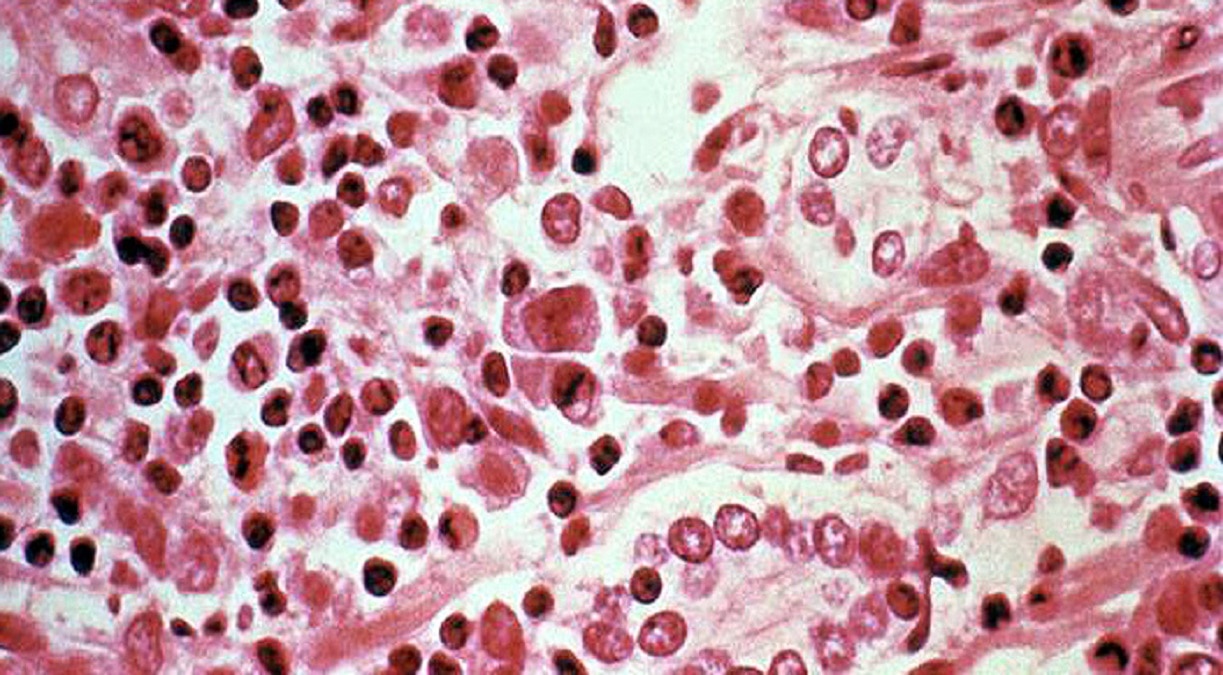 आंध्र प्रदेश में फैली अज्ञात बीमारी