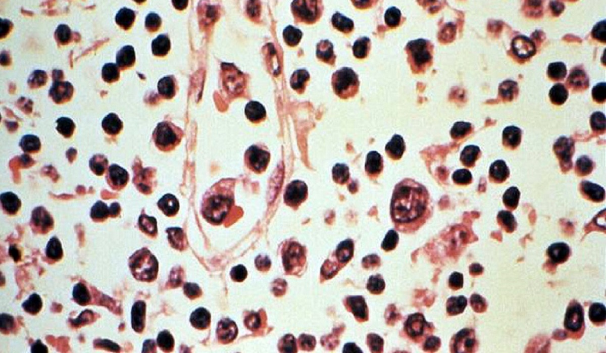 आंध्र प्रदेश में फैली अज्ञात बीमारी