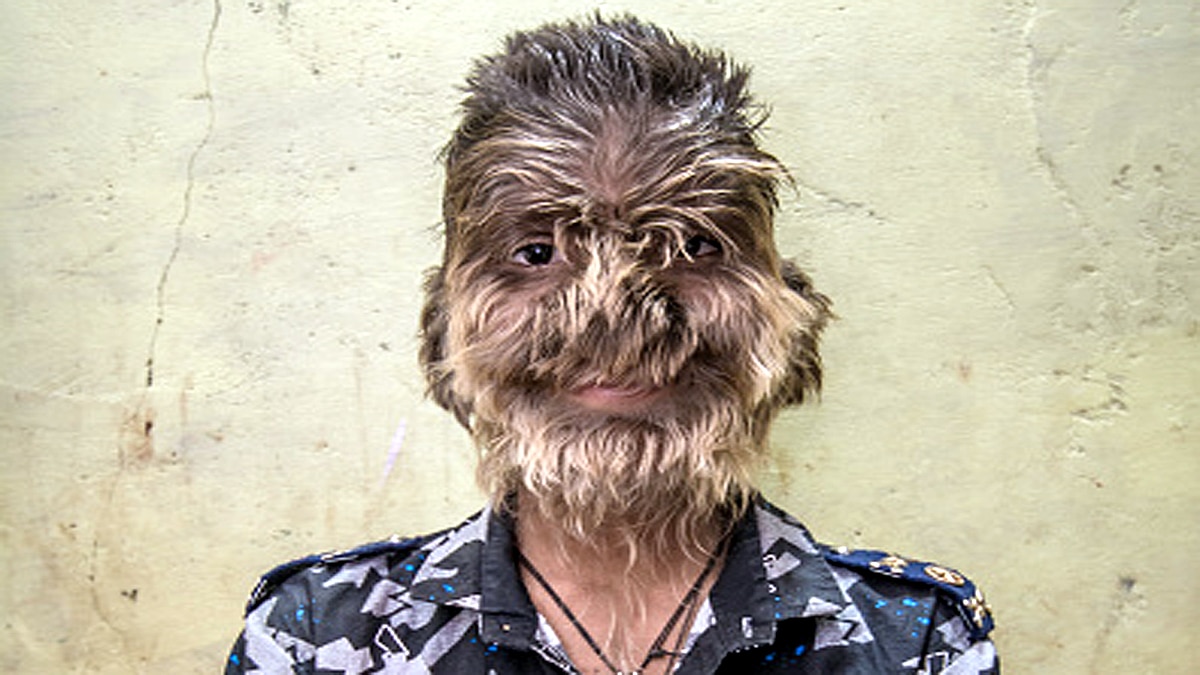 Unusual Hair Growth on Children Bodies after wrong medicine 