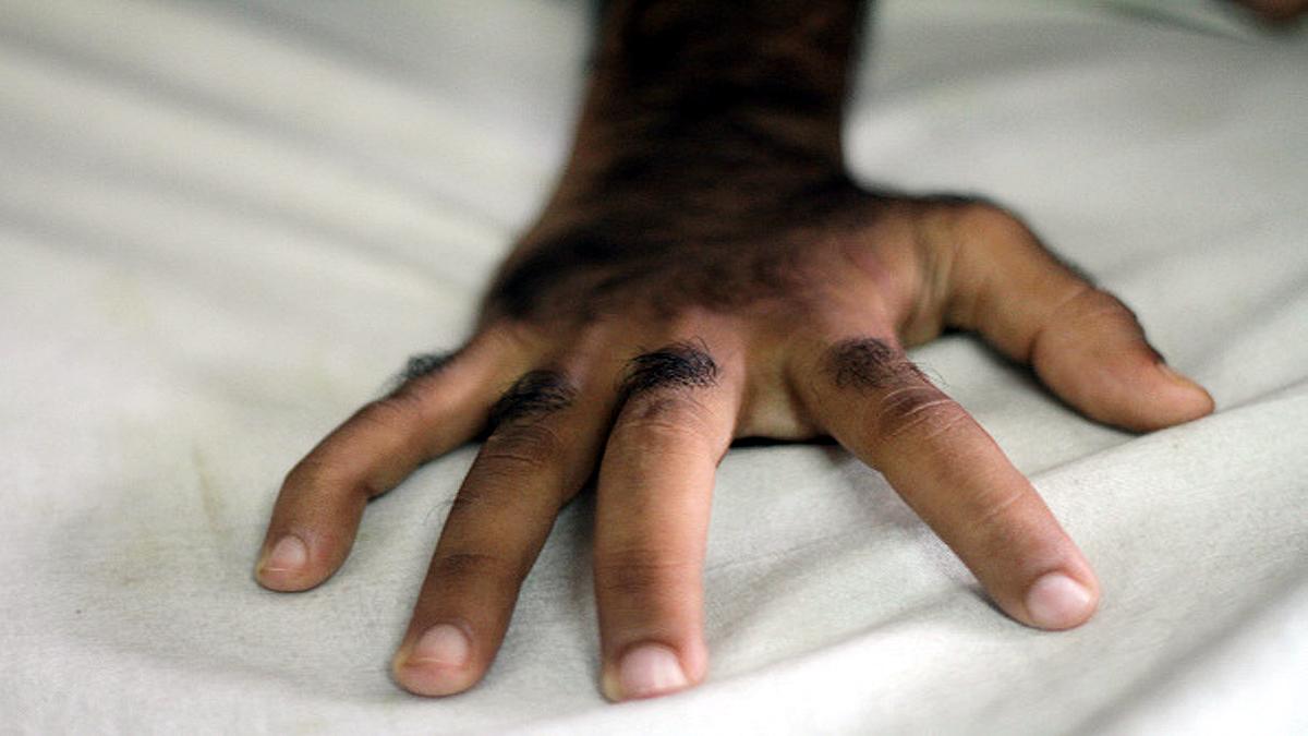 Unusual Hair Growth on Children Bodies after wrong medicine 