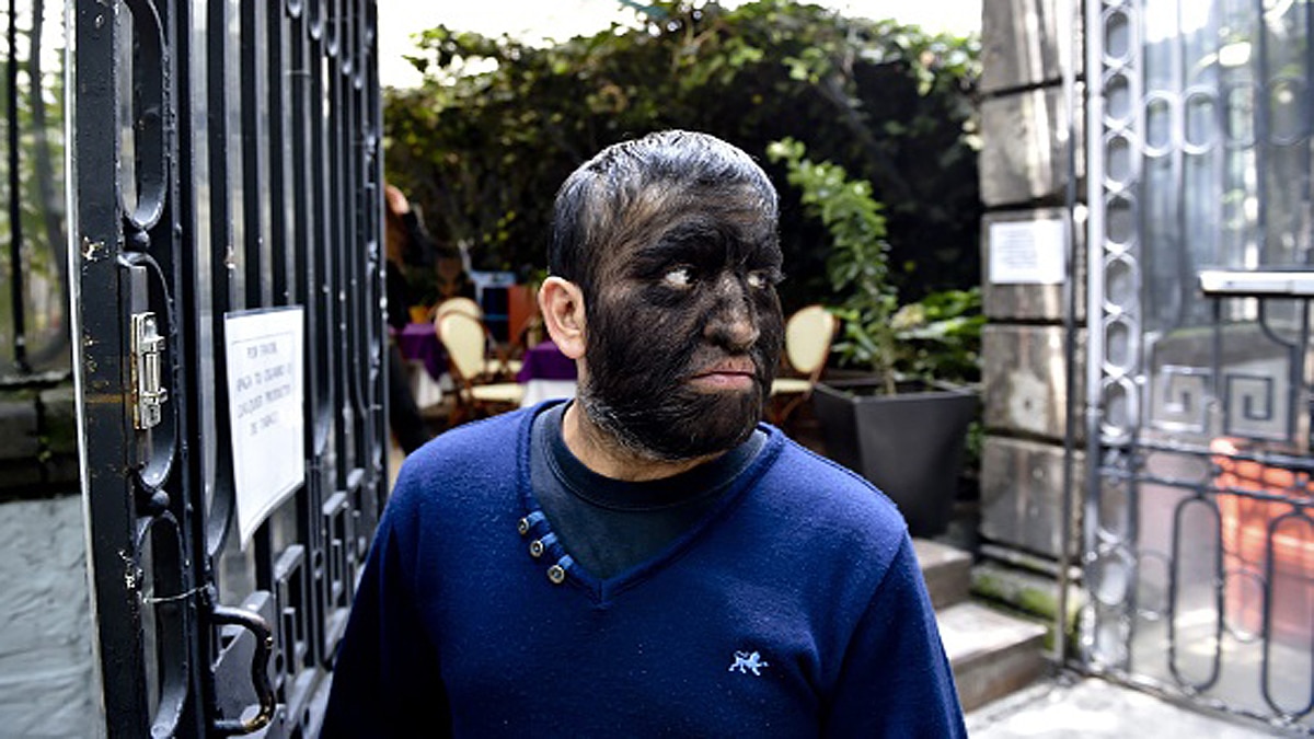 Unusual Hair Growth on Children Bodies after wrong medicine 