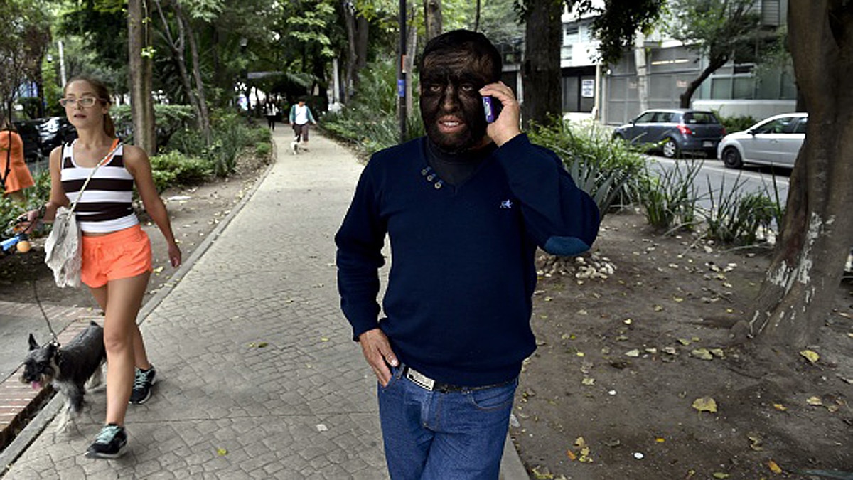 Unusual Hair Growth on Children Bodies after wrong medicine 