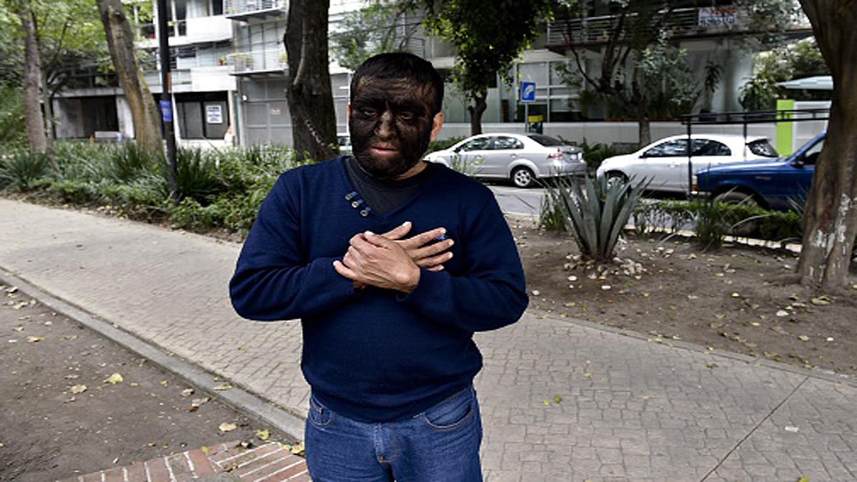 Unusual Hair Growth on Children Bodies after wrong medicine 