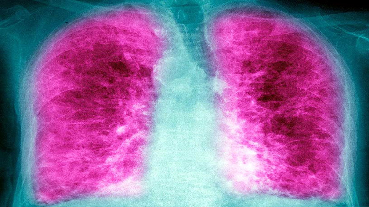 holes in corona patients lungs pneumothorax holes in corona patients lungs pneumothorax