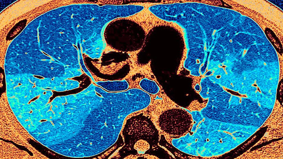 holes in corona patients lungs pneumothorax holes in corona patients lungs pneumothorax
