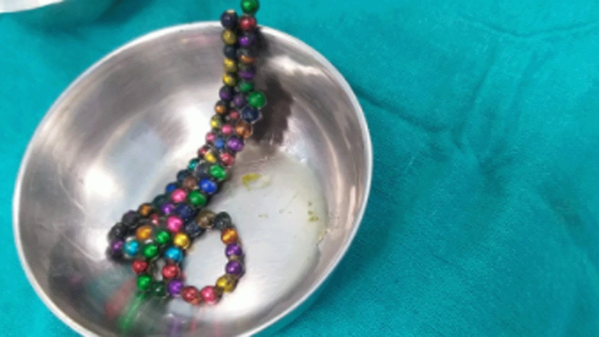 डेढ़ साल के बच्चे ने चुंबक की 65 गोलियों को निगला