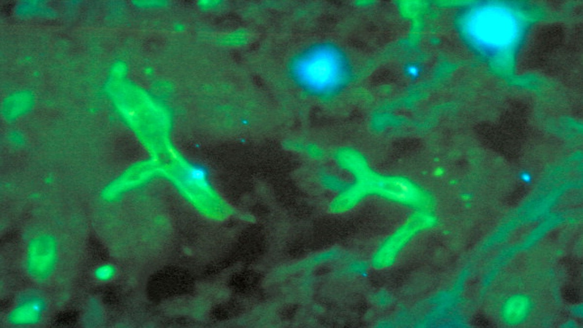 Mucormycosis is dangerous for diabetic corona patients