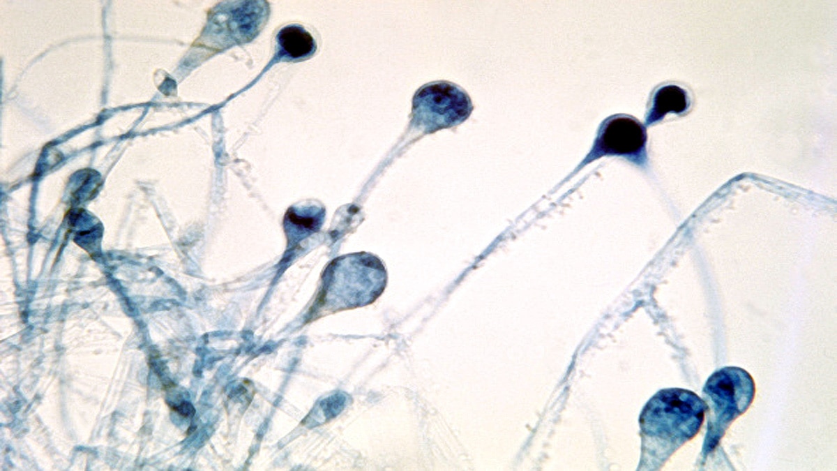 Mucormycosis is dangerous for diabetic corona patients