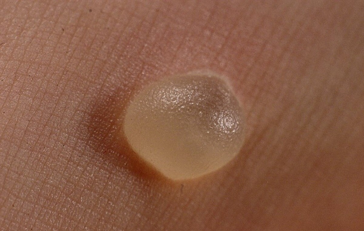 डायबिटीज 3