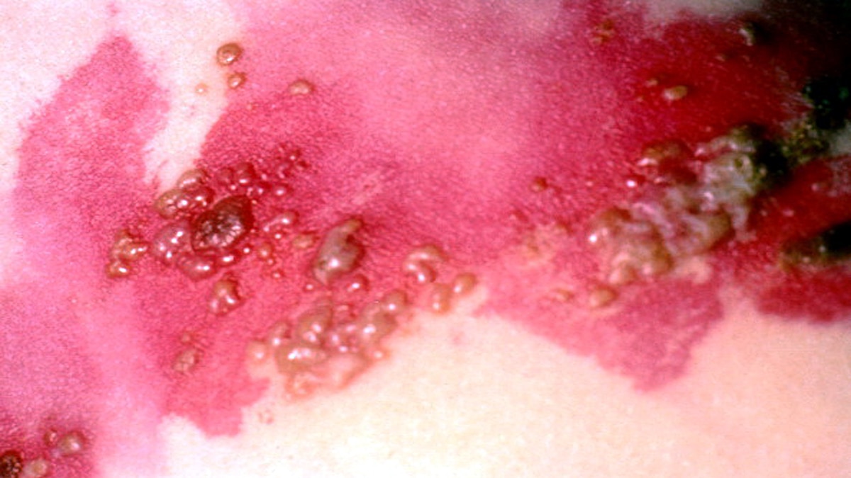 Herpes Zoster raised lymph node in Corona Patients 