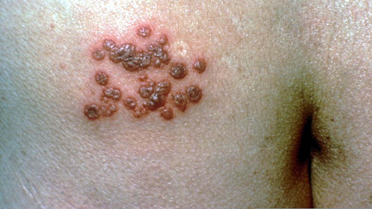 Herpes Zoster raised lymph node in Corona Patients 