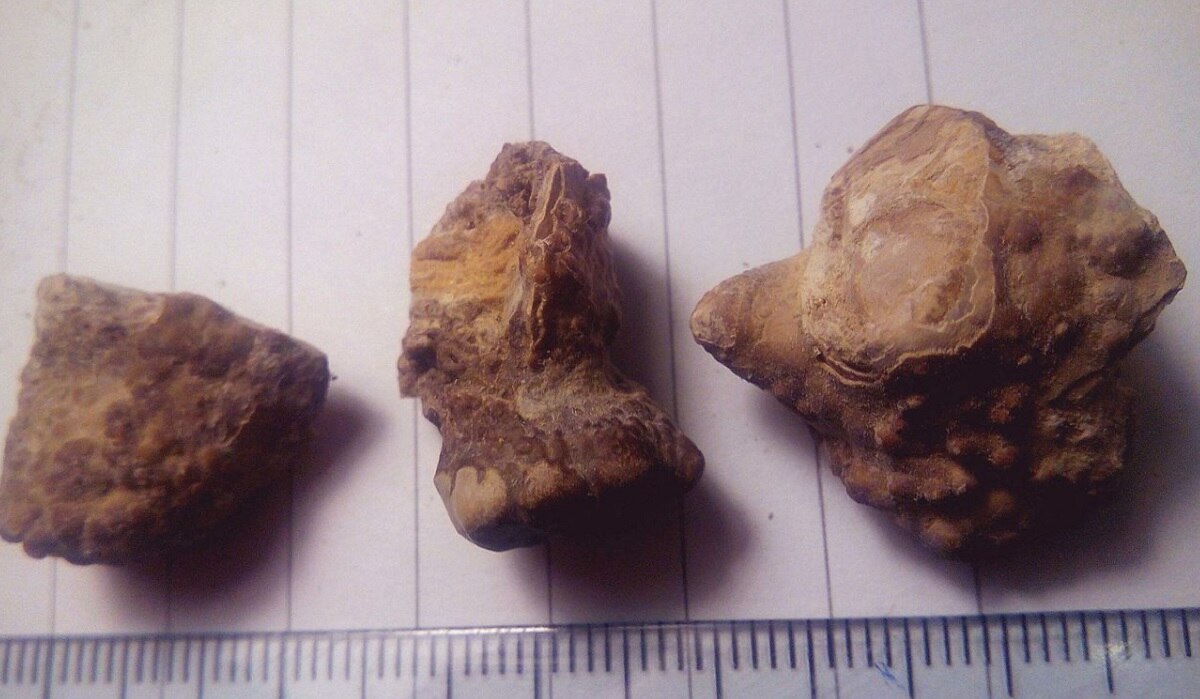 पथरी की समस्या