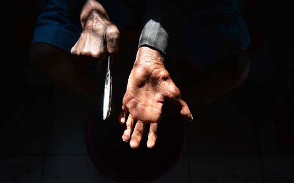 लेप्रोसी के प्रकार