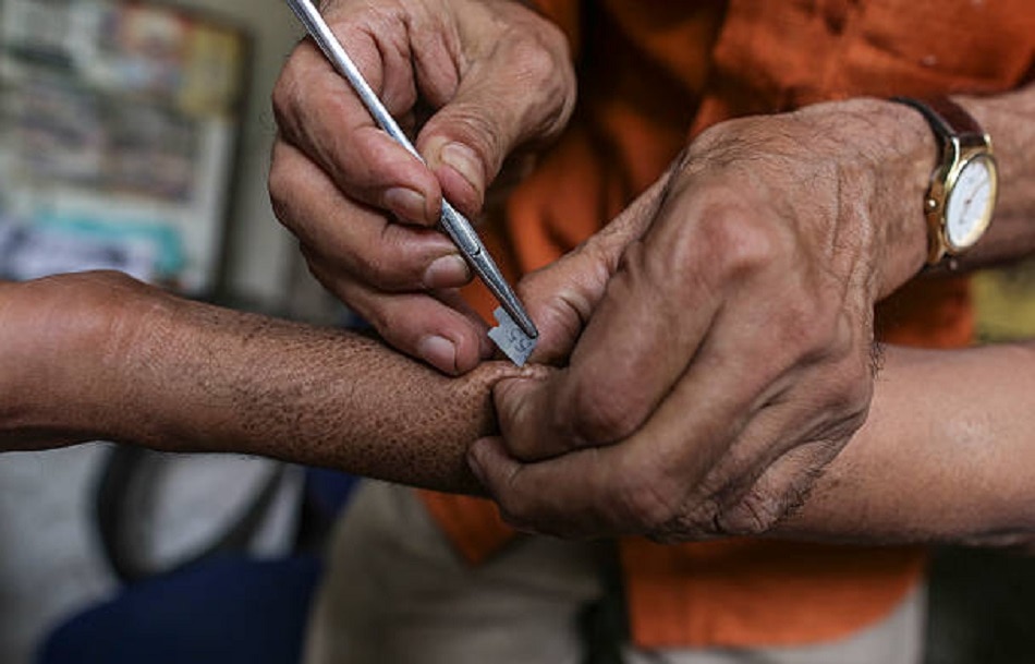 लेप्रोसी के क्या हैं लक्षण