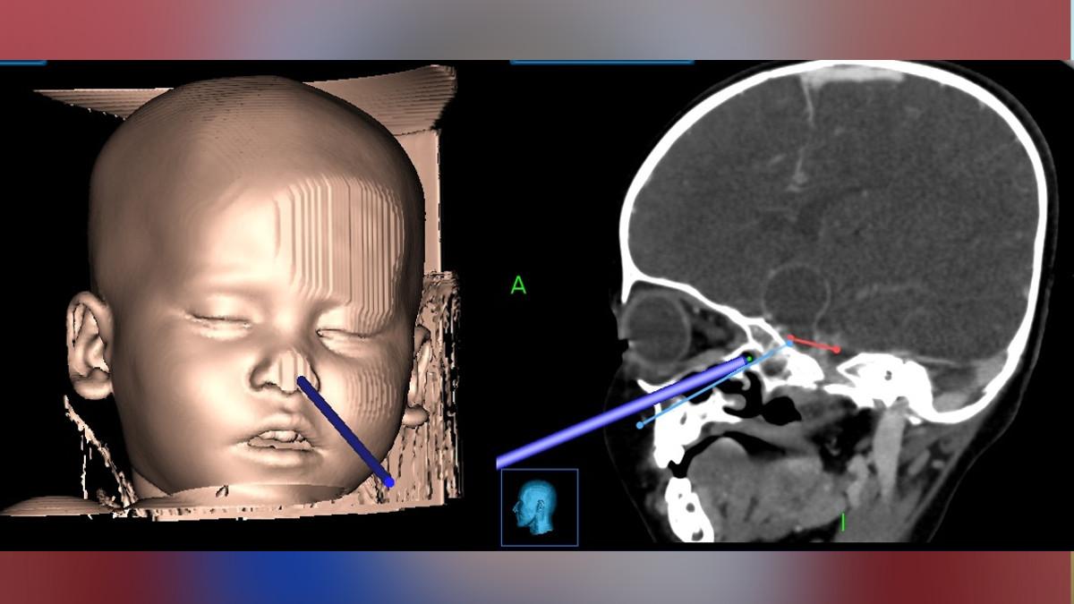 16 महीने की बच्‍ची का ब्रेन ट्यूमर का ऑपरेशन. 