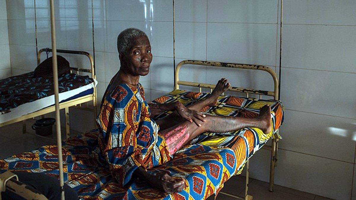 Australia Flesh Eating Disease Buruli Ulcer