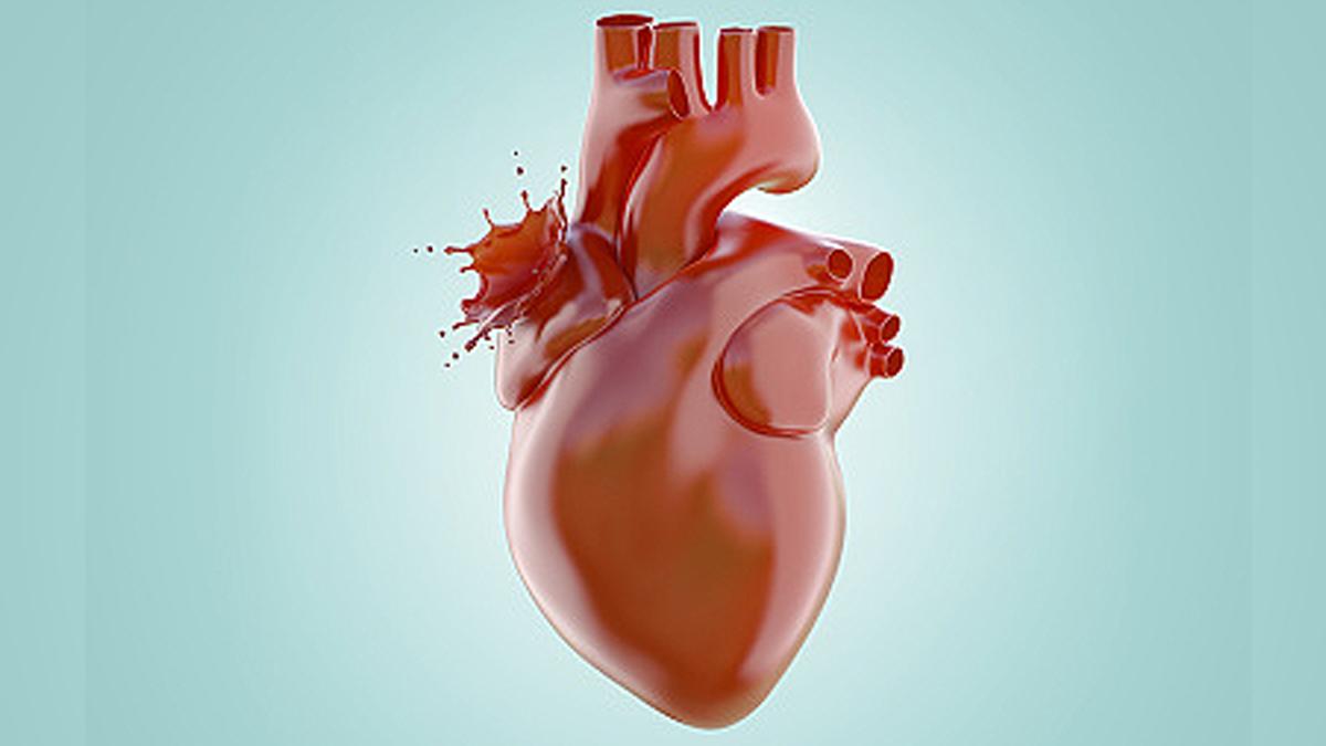 Covid-19 women Patients higher risk of dying after cardiac arrest