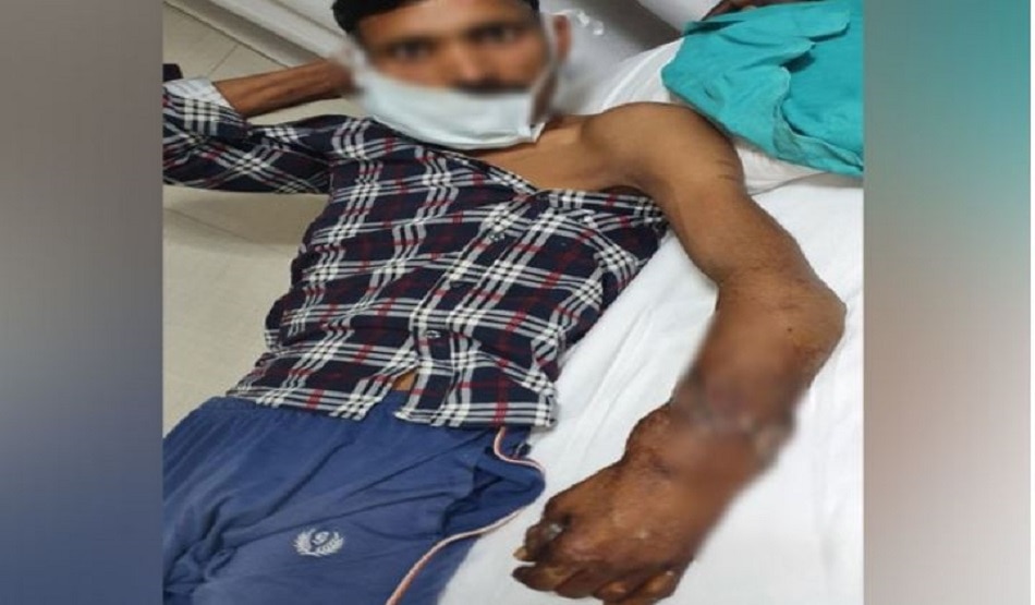 डॉक्टरों ने कटा हाथ जोड़ा