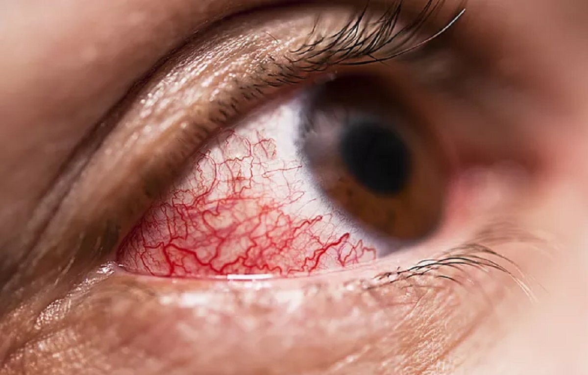 हाई ब्लड प्रेशर 2