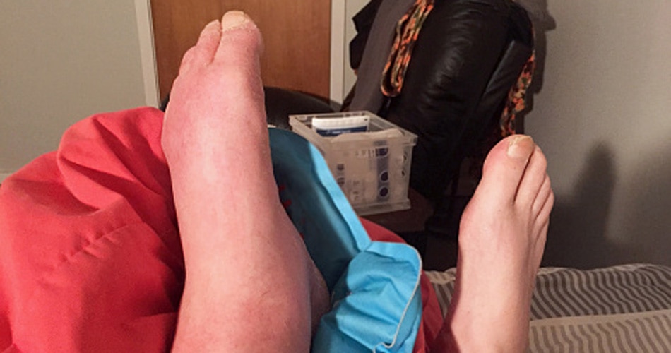 पैरों में सूजन