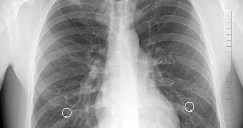 सिगरेट ना पीने वालों में फेफड़े के कैंसर के लक्षण