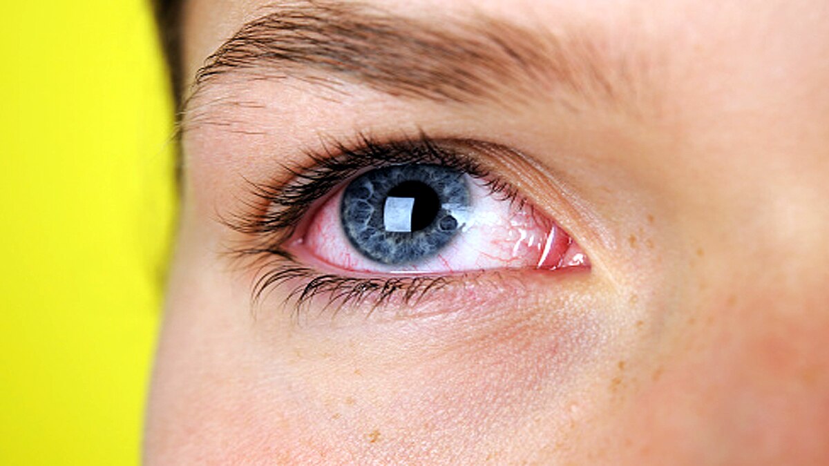 New Symptoms of New Covid-19 Strains