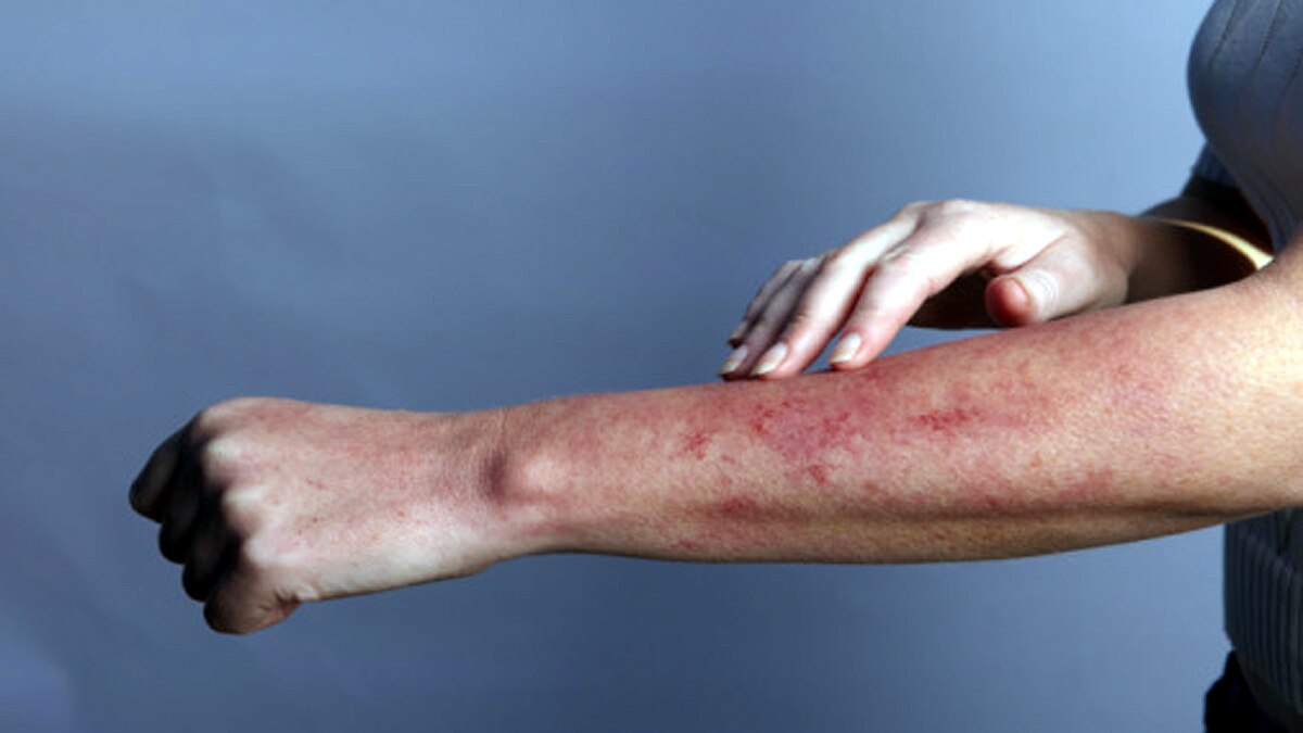 New Symptoms of New Covid-19 Strains